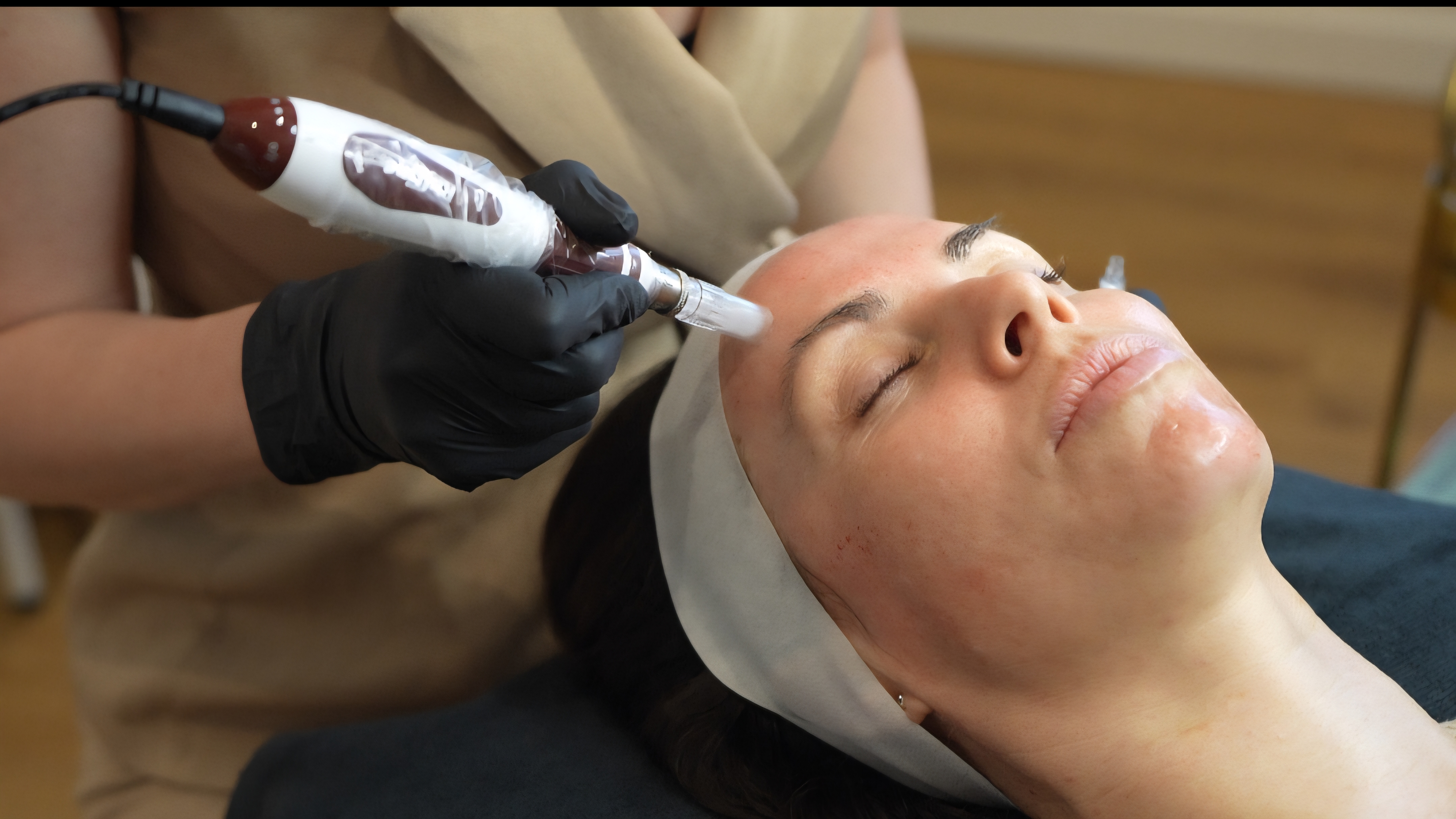 Microneedling treatment process at Aleia Aesthetics